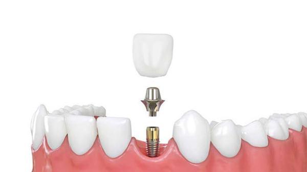 انواع ایمپلنت دندان و 3 تکنیک درمان آن